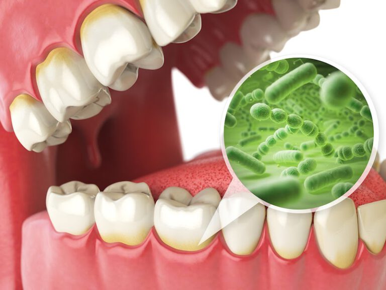 Sâu răng là gì? Nguyên nhân và triệu chứng